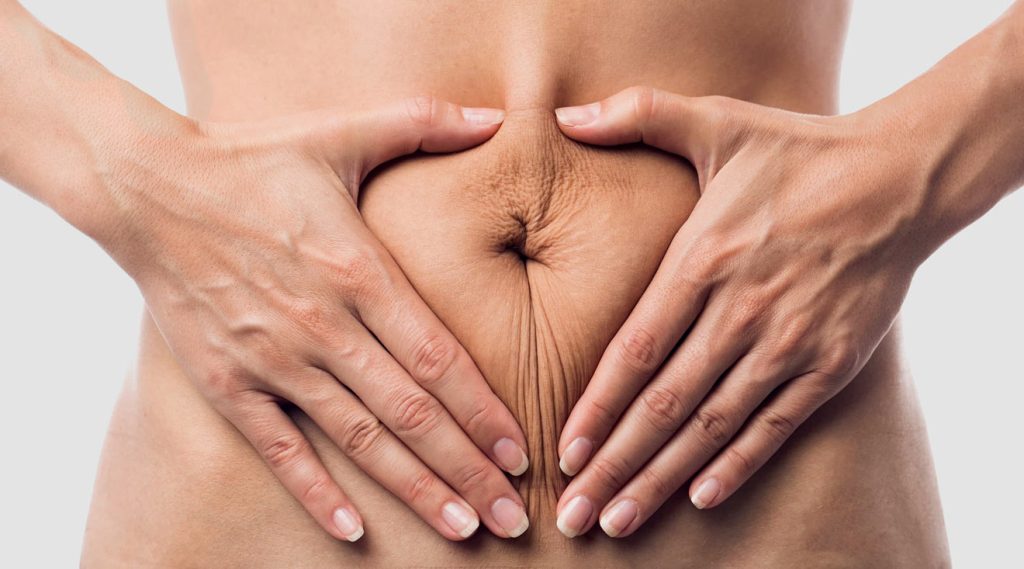 Unbehandelt kann eine Rektusdiastase langfristig zu Beschwerden wie Rückenschmerzen, Haltungsschäden oder sogar Bauchwandbrüchen führen.