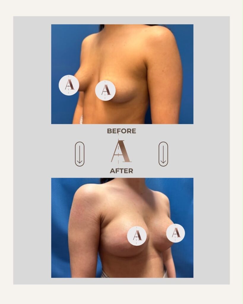 Brustvergrößerung in Wien bei Dr. Viktoria König